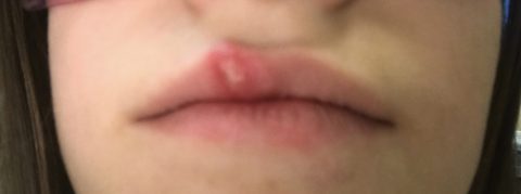 Cold sores and Laser Treatment