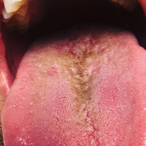 Black Hairy Tongue