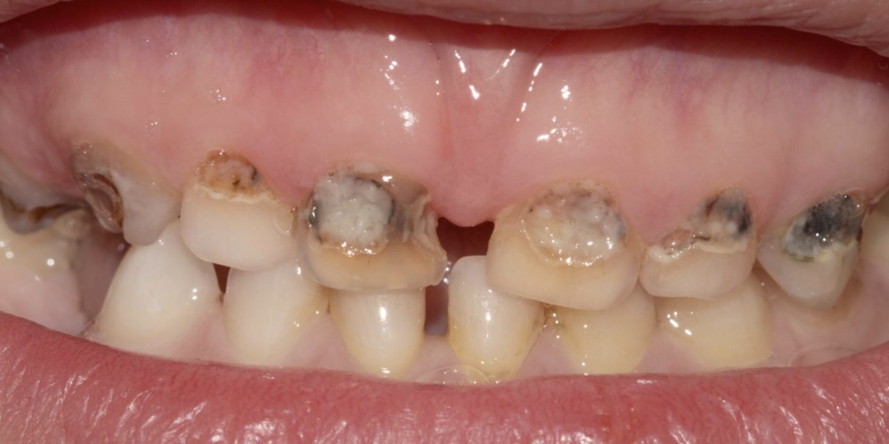 # 1 Preventable Chronic Childhood Disease | Dental Hygiene ...