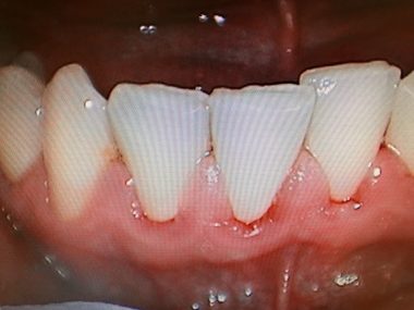 Gingivitis Cause Symptoms Prevention