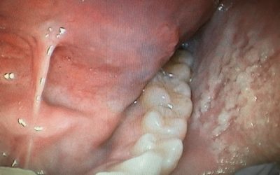 What is Oral Myofunctional Therapy (OMT)?