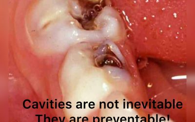 What are cavities?