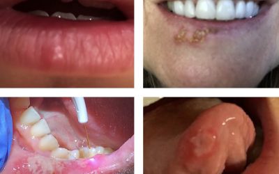 Cold Sores vs Canker Sore and Common Treatments