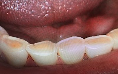Teeth Grinding