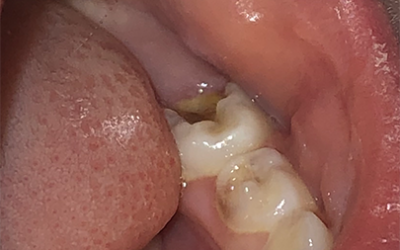 Cavities Are Preventable
