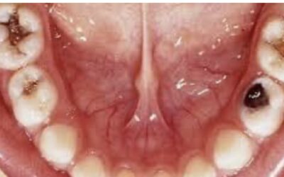 Dental Cavities (Tooth Decay)