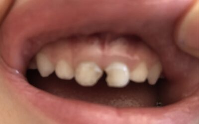 Why does my child keep getting cavities?