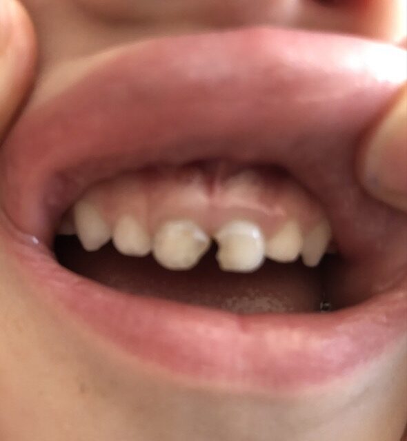 Why does my child keep getting cavities?