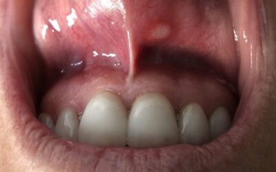Mouth Sores