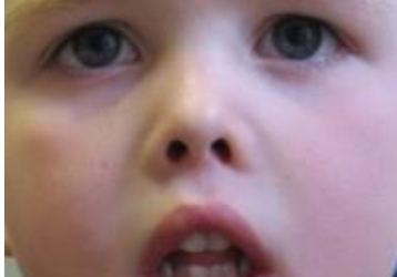 Mouth Breathing In Children