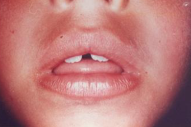 Mouth Breathing Awareness 2023