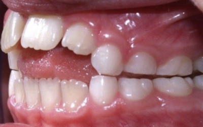 Tongue Thrust