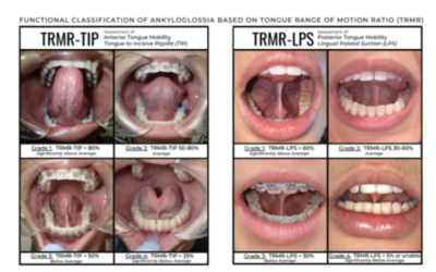 Are you Tongue Tied?