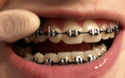 Brushing with Braces