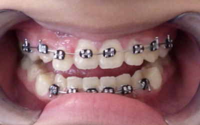 What is a Tongue Thrust Swallow and Tongue Therapy?