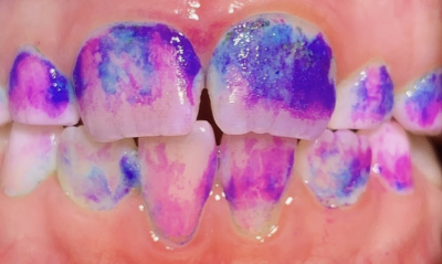 The Plaque Detective: Unveiling Oral Health Secrets with Disclosing Solutions