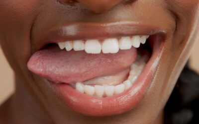 What Is Myofunctional Therapy?